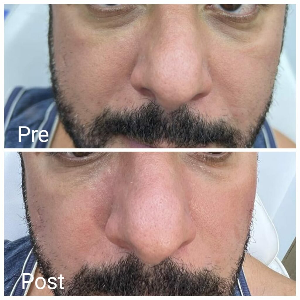 Remove dark circles for men